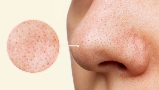 I Used to Have a Smooth Nose — Now It's Full of Pits. How Do I Fix It?