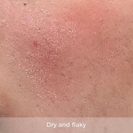 dry skin with flaky patches on face
