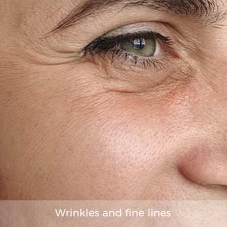 fine lines and wrinkles around eyes and mouth