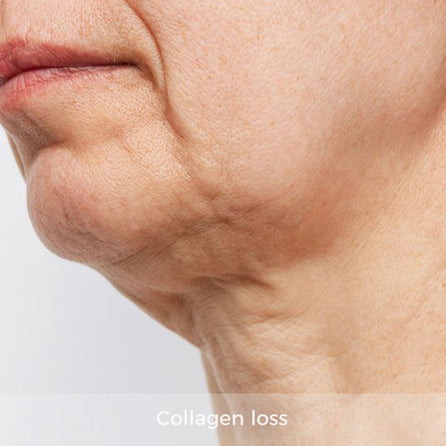 skin with loss of elasticity and sagging
